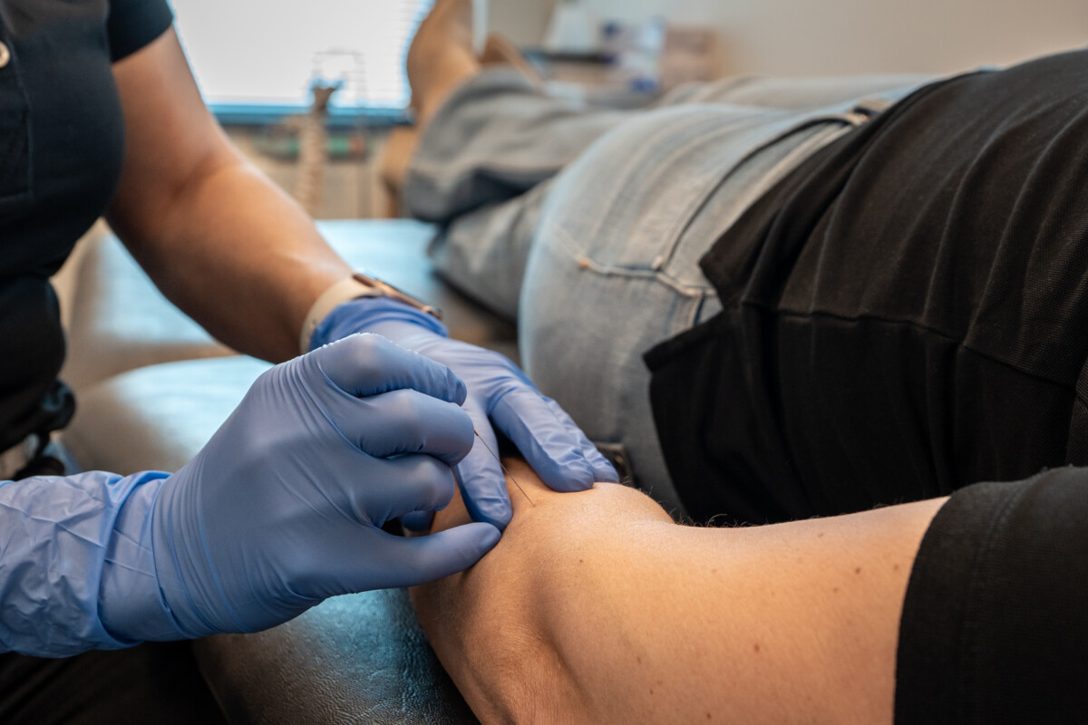 Dry needling